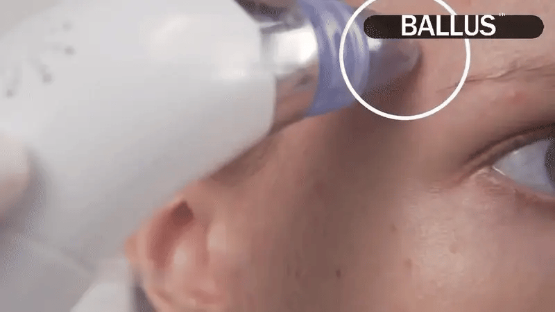 Pore Cleaning Device | جهاز تنظيف المسام